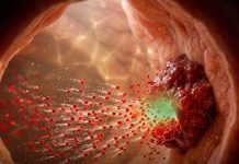 CANCERUL, ATACAT DIN INTERIOR! Cercetătorii japonezi creează un medicament experimental care se activează în celulele tumorale